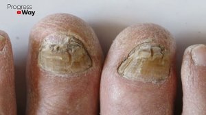 Вот, Как Убрать Грибок за 1 Минуту РАЗ И НАВСЕГДА. Избавься От ГРИБКА Ногтей На Ногах!