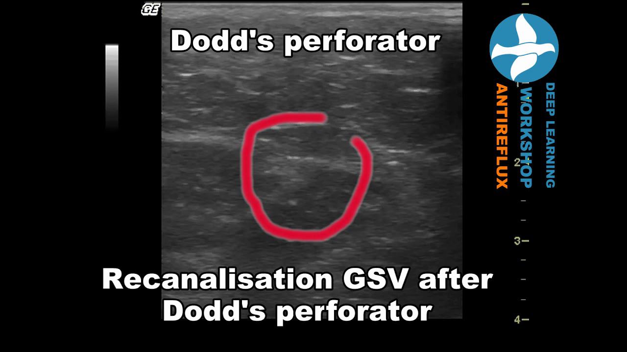 Racanalisation GSV after Dodd's perforator смотреть онлайн