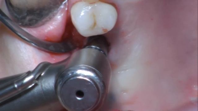 Установка дентального имплантанта (врач-стоматолог хирург Шахкулян С.М.) смотреть онлайн