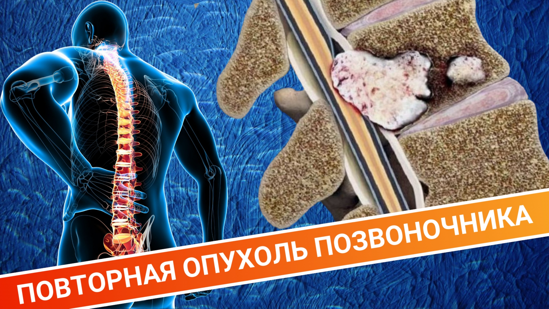 ВТОРИЧНАЯ ОПУХОЛЬ ПОЗВОНОЧНИКА смотреть онлайн