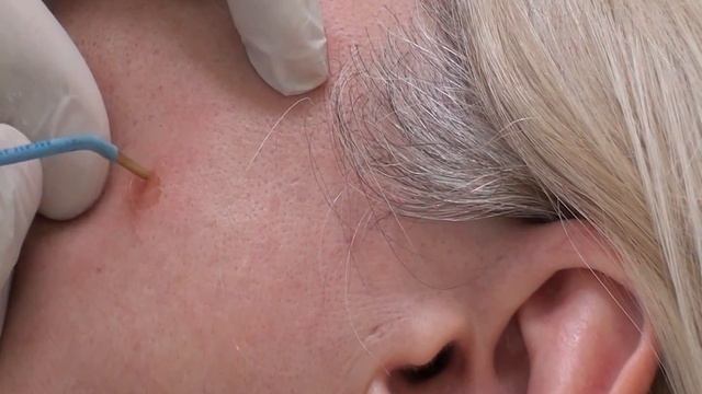 Удаление кератомы щеки игольчатым элеткрод TF1 смотреть онлайн