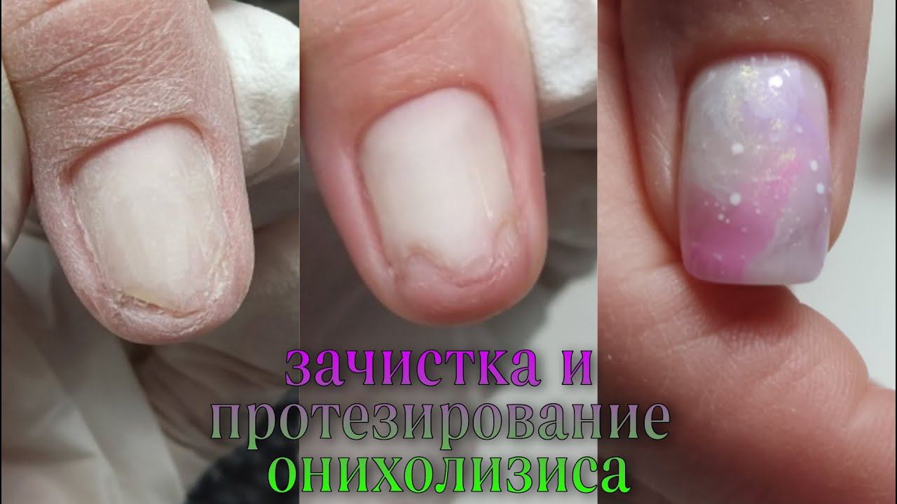 ОНИХОЛИЗИС Зачистка и протезирование смотреть онлайн