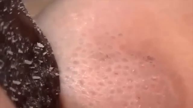 Black Mask - маска против прыщей и черных точек смотреть онлайн