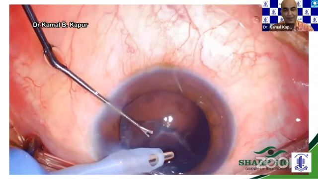 Surgical Strike in Phacoemulsification смотреть онлайн