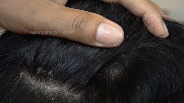 Psoriasis Scalp Scratching Huge Flakes Satisfying #735