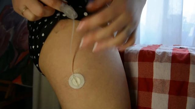 Катетеры ШуаТи (Sure-T) обзор. Как выглядит игла ШуаТи от Medtronic смотреть онлайн