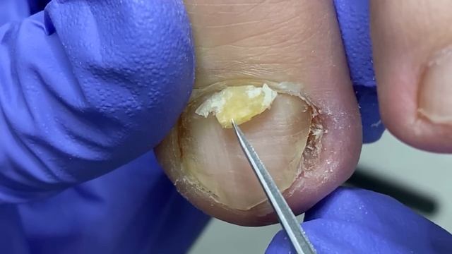 Trim common onychomycosis, pay attention to daily care【Doctor Liu Pedicure】 смотреть онлайн