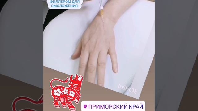Армирование кистей рук филлером гиалуроновой кислоты канюлей. смотреть онлайн