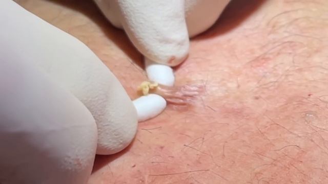 Steatocystoma Multiplex. Dozens of extractions on the chest. Chronic condition. MrPopZit. смотреть онлайн