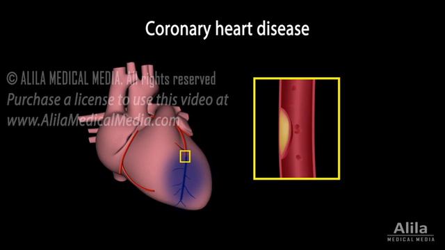 Coronary Circulation and Revascularization, Animation смотреть онлайн