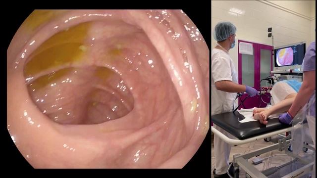 Как делать колоноскопию. Многопрофильная клиника "Скандинавия".How to perform colonoscopy procedur смотреть онлайн