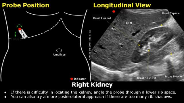 Kidney Ultrasound Probe Positioning | Transducer Placement & Scanning | Abdominal USG | Sonography смотреть онлайн