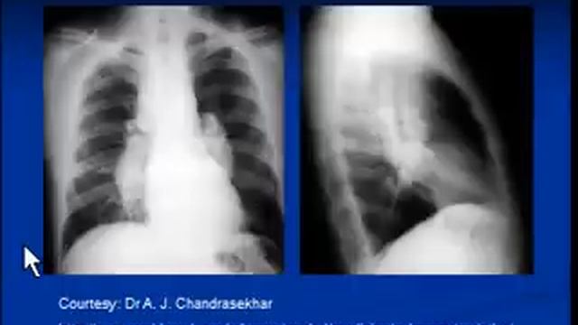Chest x-ray --interpretation -Sarcoidosis смотреть онлайн