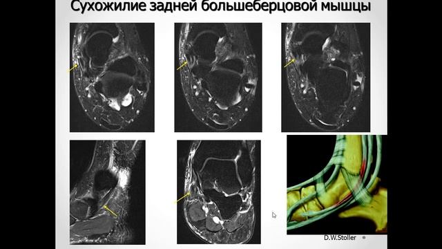 Базовый курс по МРТ b Лекция «МР семиотика повреждений голеностопного сустава» Учеваткин_№2 смотреть онлайн