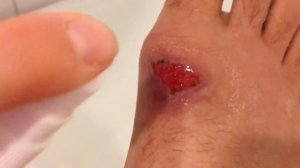 Чем обработать открытую рану