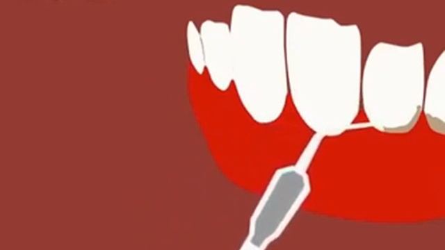 Ультразвуковая чистка зубов смотреть онлайн