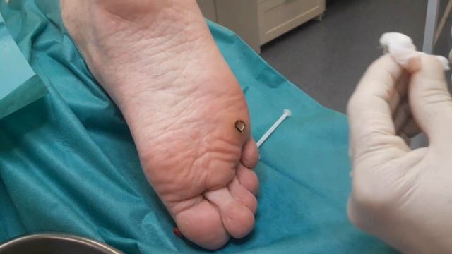 Удаление шипицы - бородавки радиоволной с комментариями врача смотреть онлайн