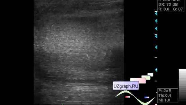 УЗИ мошонки - Утолщение стенки мошонки смотреть онлайн