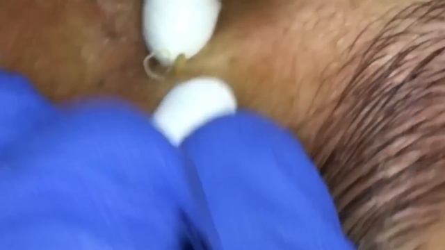Blackheads Extractions Justin 1st Treatment смотреть онлайн