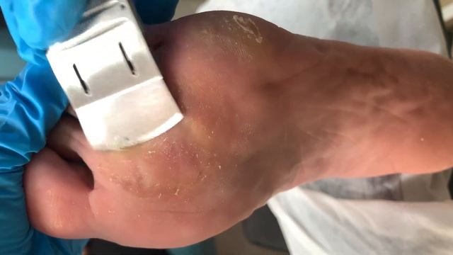 Callus removal from feet&Foot scraping dead skin【Xiao Yan pedicure】#stress 39 смотреть онлайн
