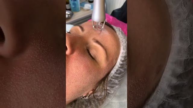 Лазерная шлифовка смотреть онлайн