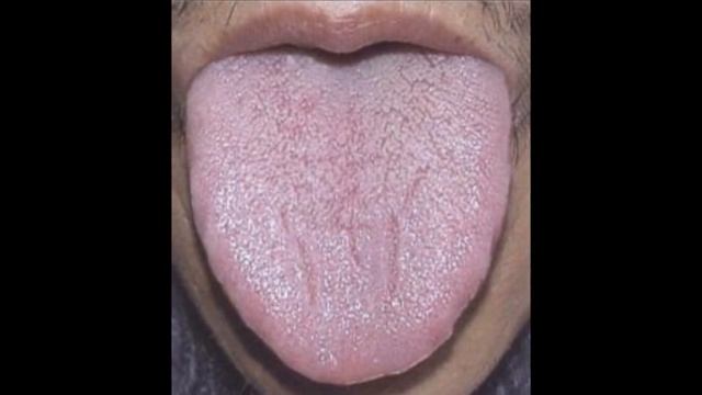 Трещины на языке