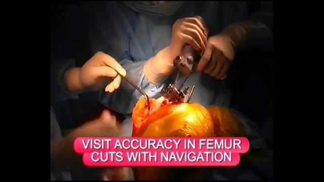 Dr. Akhil Dadi's Experience on Knee Navigation Surgery смотреть онлайн