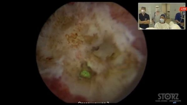 Лазерная резекция опухоли мочевого пузыря (Макаров П.А., Горно-Алтайск)