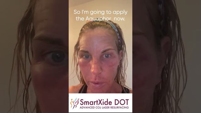 Getting Started - SmartXIDE DOT CO2 Laser Skin Resurfacing Day By Day Actual Patient Live Video ...