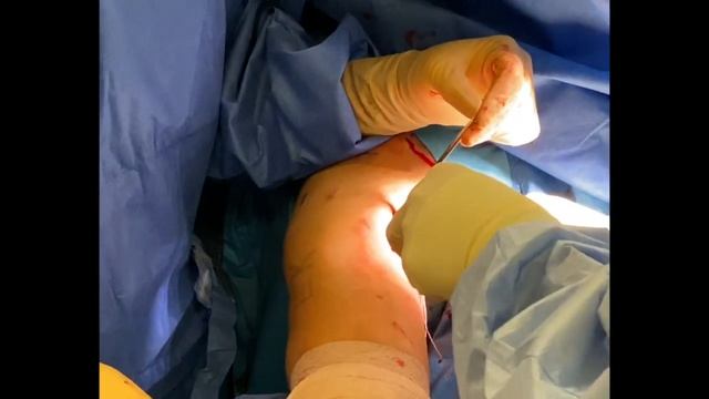 Open Biceps Tenodesis - Open BT смотреть онлайн