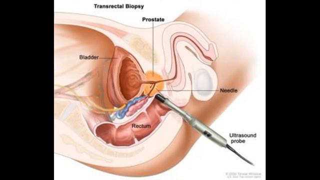 простата бези САРАТОН КАСАЛЛИГИ текшириш смотреть онлайн