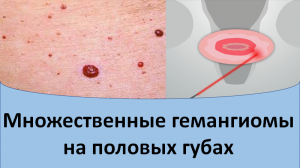 Множественные гемангиомы на половых губах