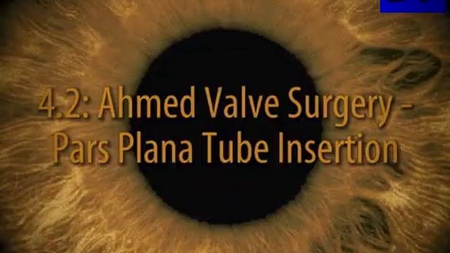Хирургия глаукомы  (Glaucoma Surgery) - 4