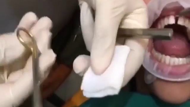 Diastema treatment / Лечение диастемы смотреть онлайн