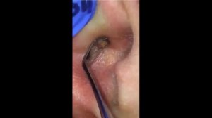 Новое видео. Удаление угрей  черных точек. New video. Removing blackheads.