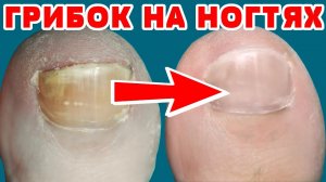Грибок на ногах не приговор! От запущенной формы к здоровым ногтям!