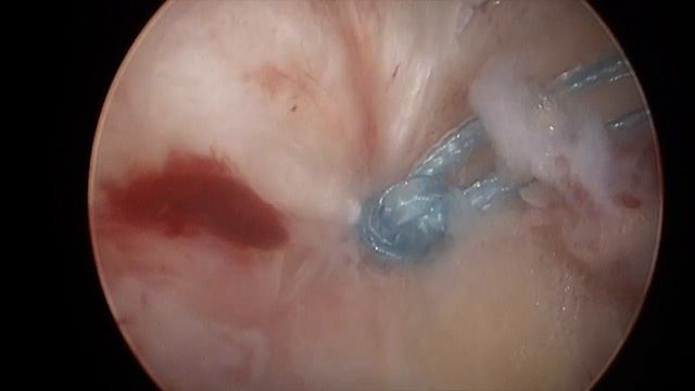 Arthroscopic Rotator Cuff Repair смотреть онлайн