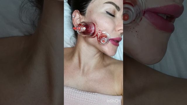 Хиджама лица (Капилляротерапия). Инстаграм @cosmetolog_hijama смотреть онлайн