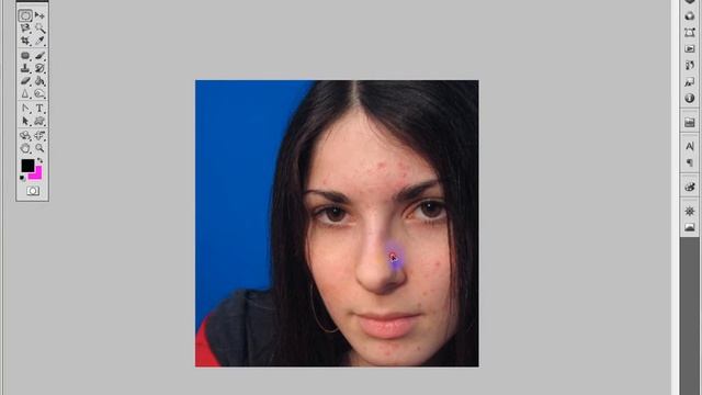 Урок по фотошопу. Убираем прыщи.