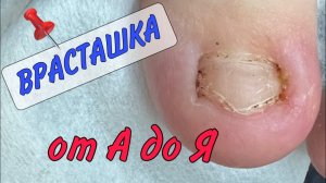 Врастающий ноготь_ вросший ноготь _скоба для ногтей