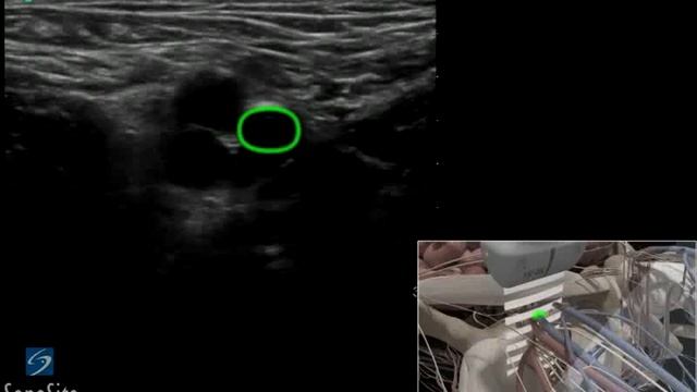 3D-пособие: Катетеризация бедренной вены под контролем ультразвука смотреть онлайн