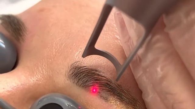 Видалення татуажу брів лазером надкороткого імпульсу PICO-LIGHT BRILLIANT смотреть онлайн