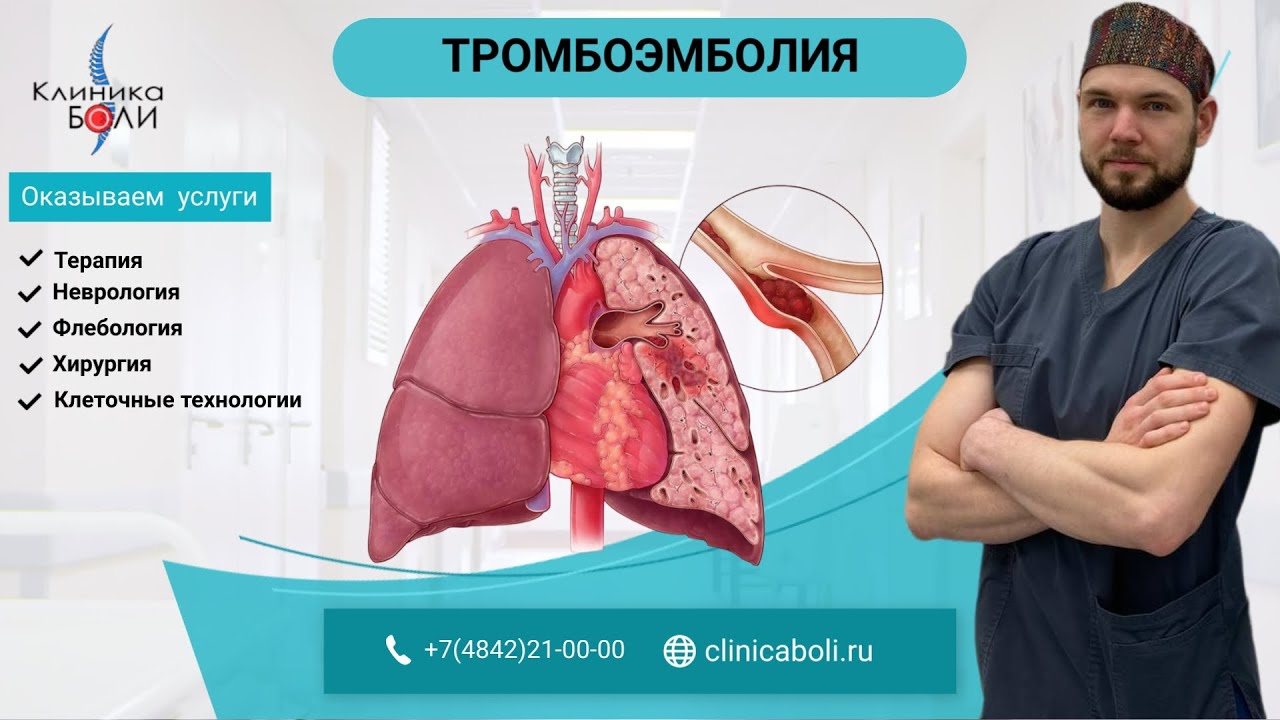 ТРОМБОЭМБОЛИЯ. ТРОМБ ОТОРВАЛСЯ? смотреть онлайн
