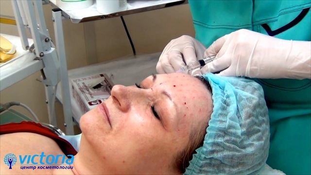 Биоревитализация препаратом Revi