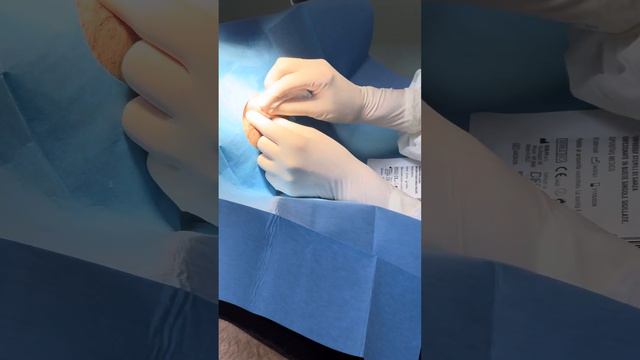 DRENAGGIO DI CISTI SEBACEA DEL VOLTO ! смотреть онлайн