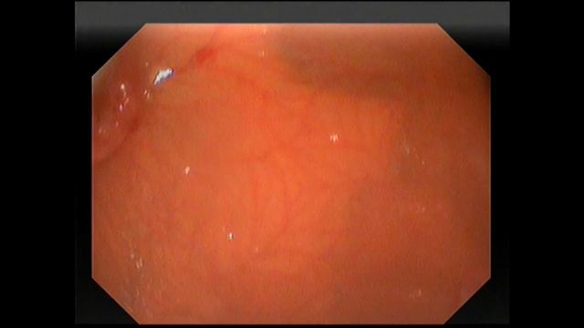 лимфома пищевода и желудка у кошки смотреть онлайн