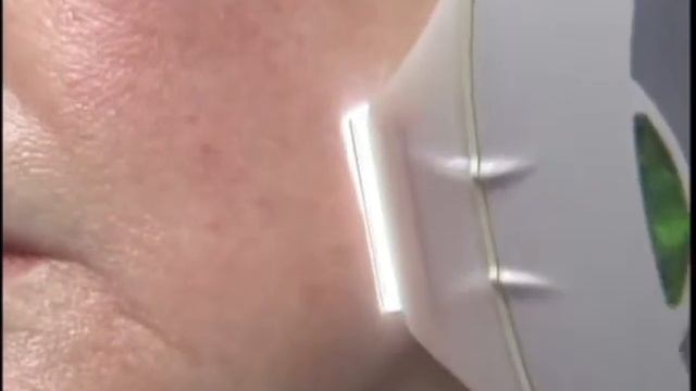 Cutera IPL LimeLight - leziuni pigmentare смотреть онлайн