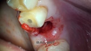 Ушивание перфорации гайморовой пазухи лоскутом на ножке