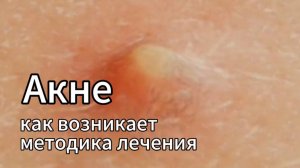 Акне, причины возникновения, разновидности, способы борьбы в зависимости от стадии.