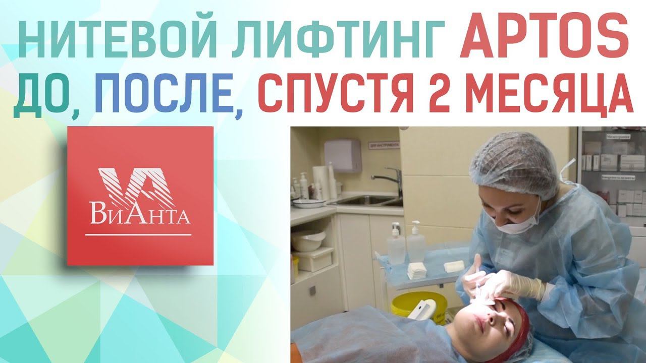Нитевой лифтинг АПТОС (APTOS). Клиника 